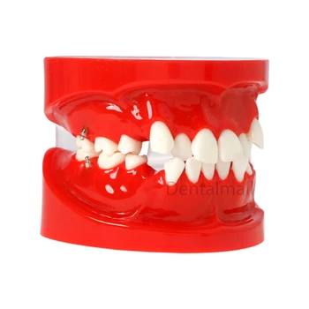 Стоматологично ортодонтско лечение Модел на зъбите за демонстриране на ортодонтско лечение 3005